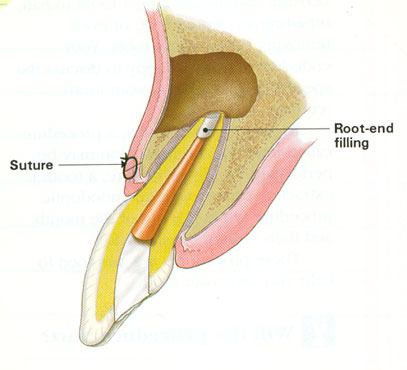 root canal surgery/apicoectomy